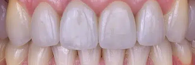 After Treatment - Composite Veneers in Pocatello, ID - Modern Smiles