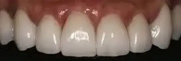 After Treatment - Porcelain Bridges in Pocatello, ID - Modern Smiles