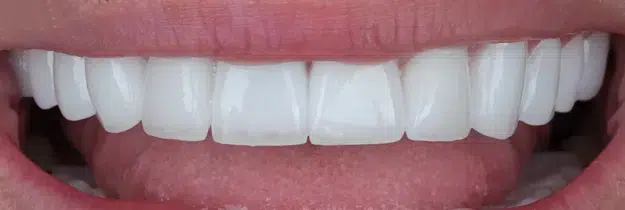 After Treatment - Porcelain Crowns in Pocatello, ID - Modern Smiles