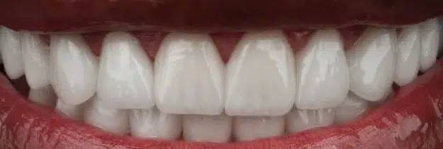 After Treatment - Porcelain Veneers in Pocatello, ID - Modern Smiles