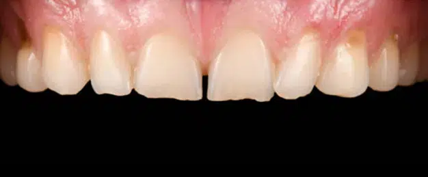 Before Treatment - Composite Fillings in Pocatello, ID - Modern Smiles