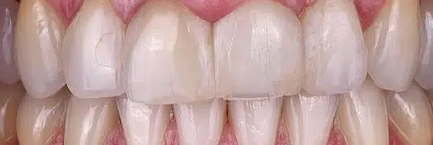 Before Treatment - Composite Veneers in Pocatello, ID - Modern Smiles