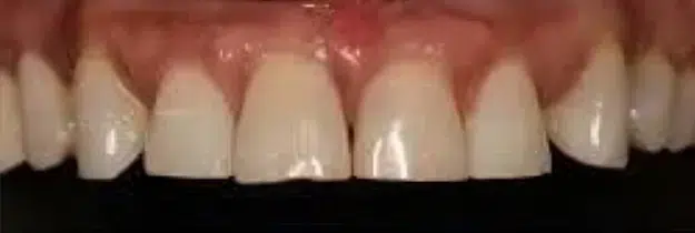 Before Treatment - Porcelain Bridges in Pocatello, ID - Modern Smiles