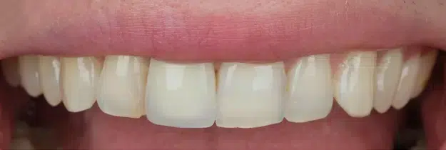 Before Treatment - Porcelain Crowns in Pocatello, ID - Modern Smiles