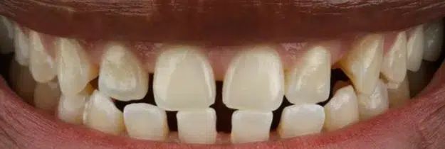 Before Treatment - Porcelain Veneers in Pocatello, ID - Modern Smiles