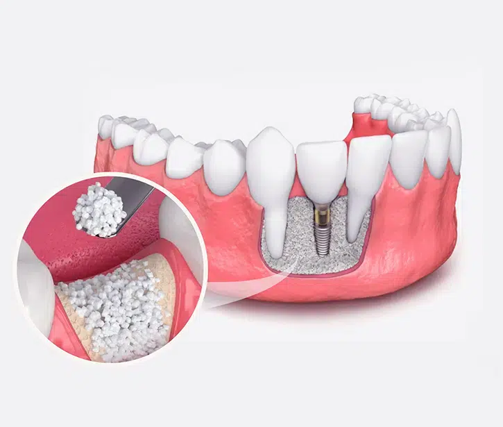 Bone Grafting in Pocatello, ID - Modern Smiles