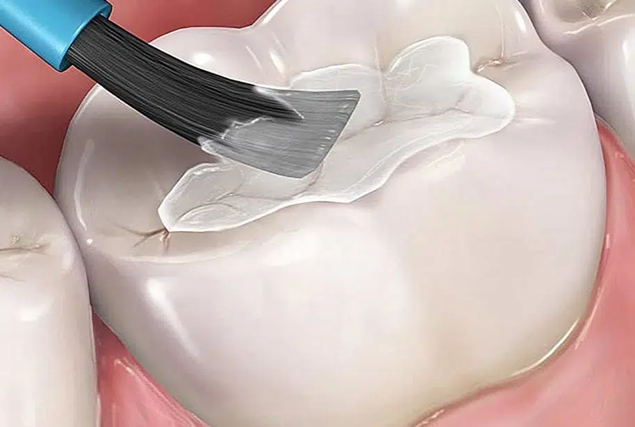 Dental Sealants in Pocatello, ID - Modern Smiles