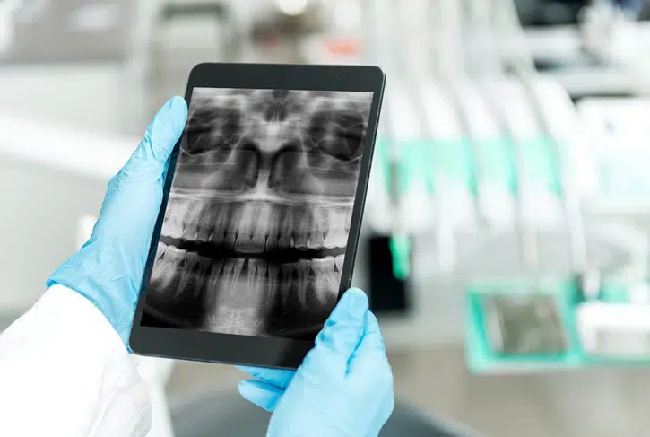 Digital Dental X-Rays in Pocatello, ID - Modern Smiles