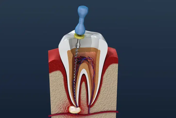 Endodontic Surgery in Pocatello, ID - Modern Smiles