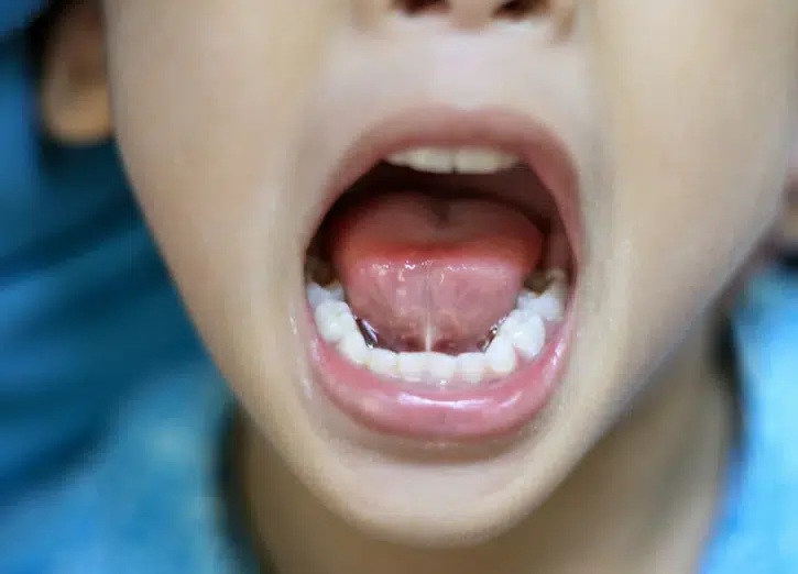 Frenectomy in Pocatello, ID - Modern Smiles