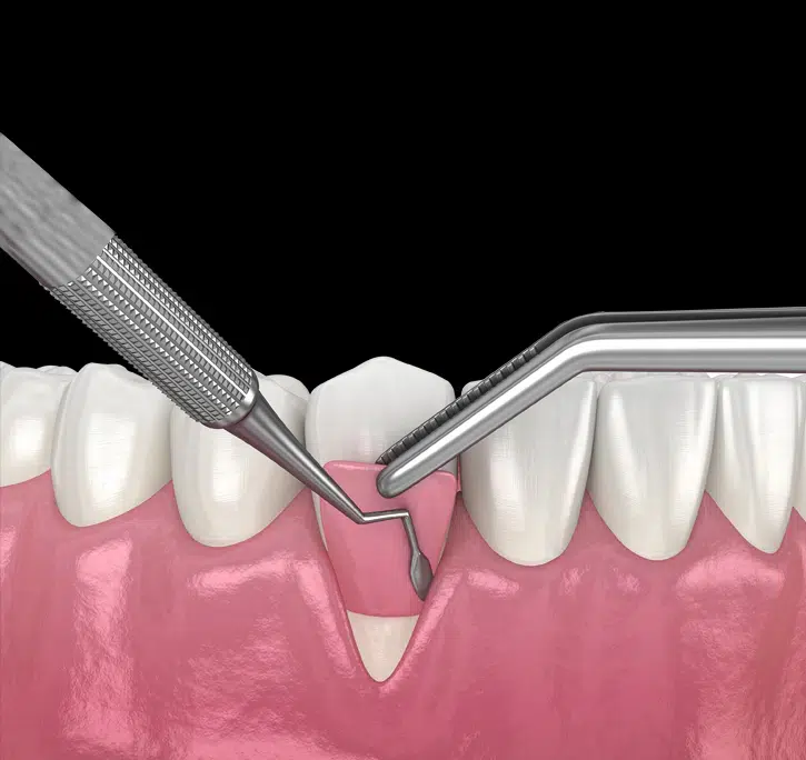 Gum Grafting in Pocatello, ID - Modern Smiles