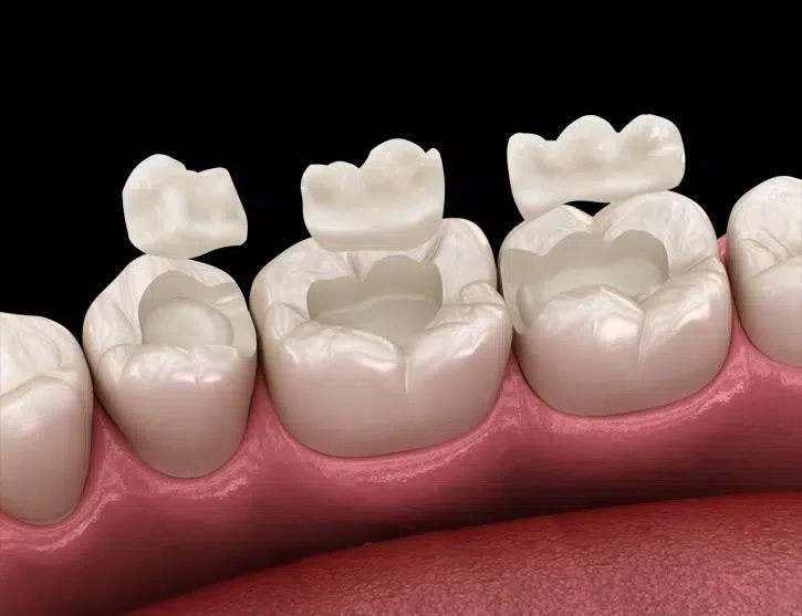 Inlays and Onlays in Pocatello, ID - Modern Smiles