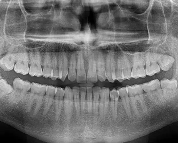 Panorex in Pocatello, ID - Modern Smiles
