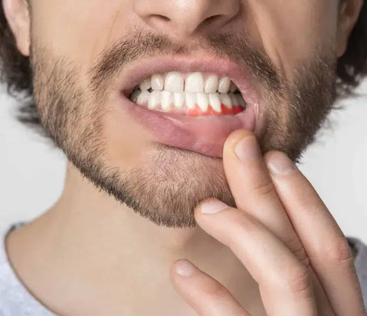 Periodontal (Gum) Disease Treatment in Pocatello, ID - Modern Smiles