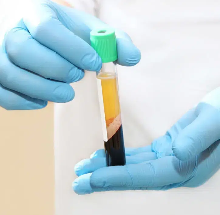 Platelet-Rich Plasma in Pocatello, ID - Modern Smiles