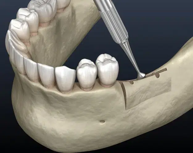 Ridge Augmentation in Pocatello, ID - Modern Smiles