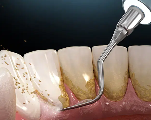 Scaling and Root Planing in Pocatello, ID - Modern Smiles