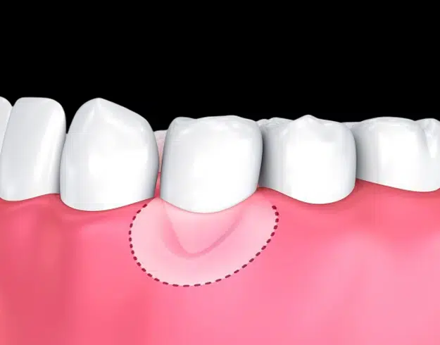 Soft Tissue Grafting in Pocatello, ID - Modern Smiles