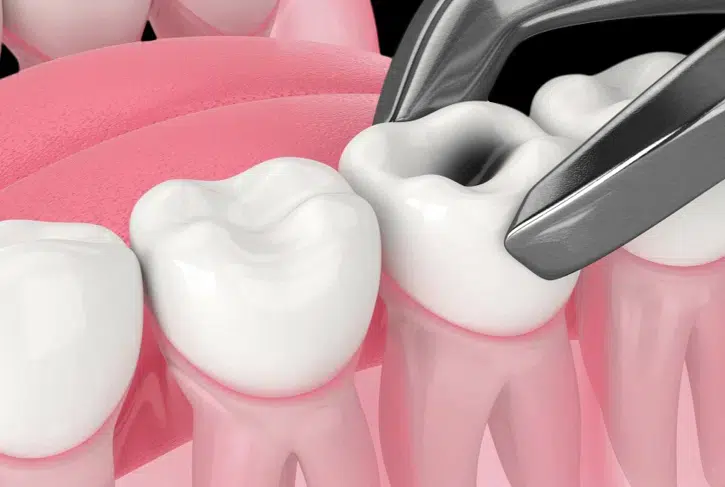 Tooth Extractions in Pocatello, ID - Modern Smiles