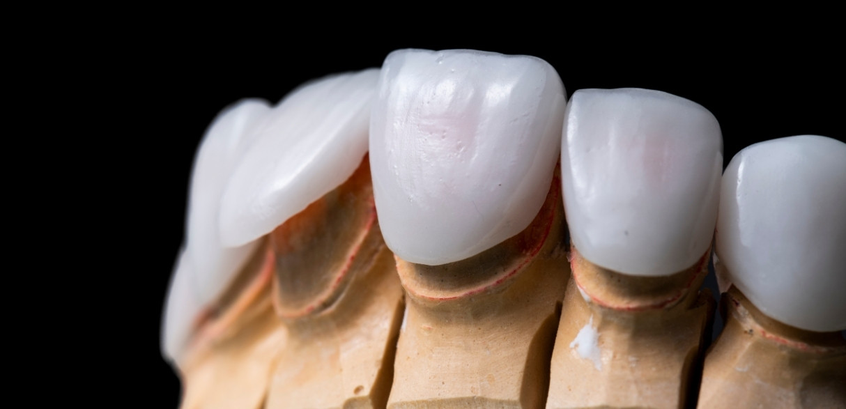 are veneers viable options with missing teeth