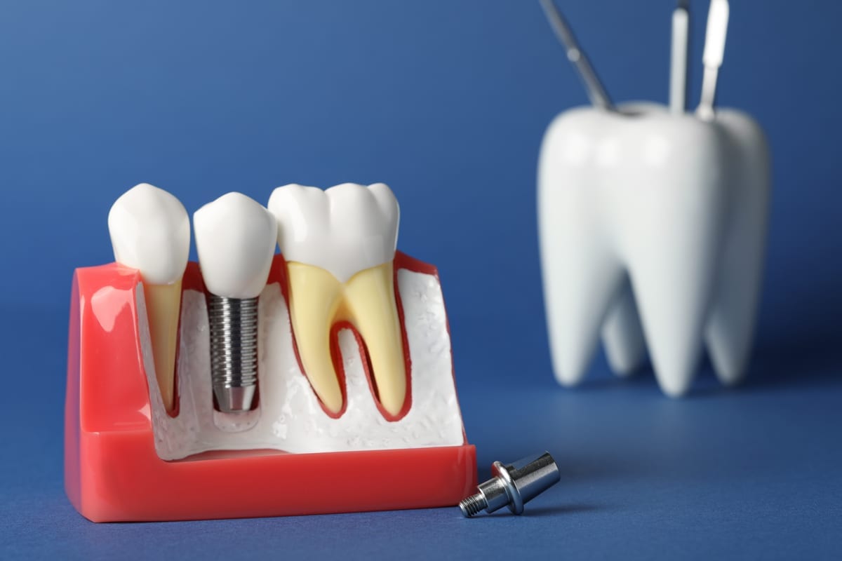 Dental Implants in Chubbuck