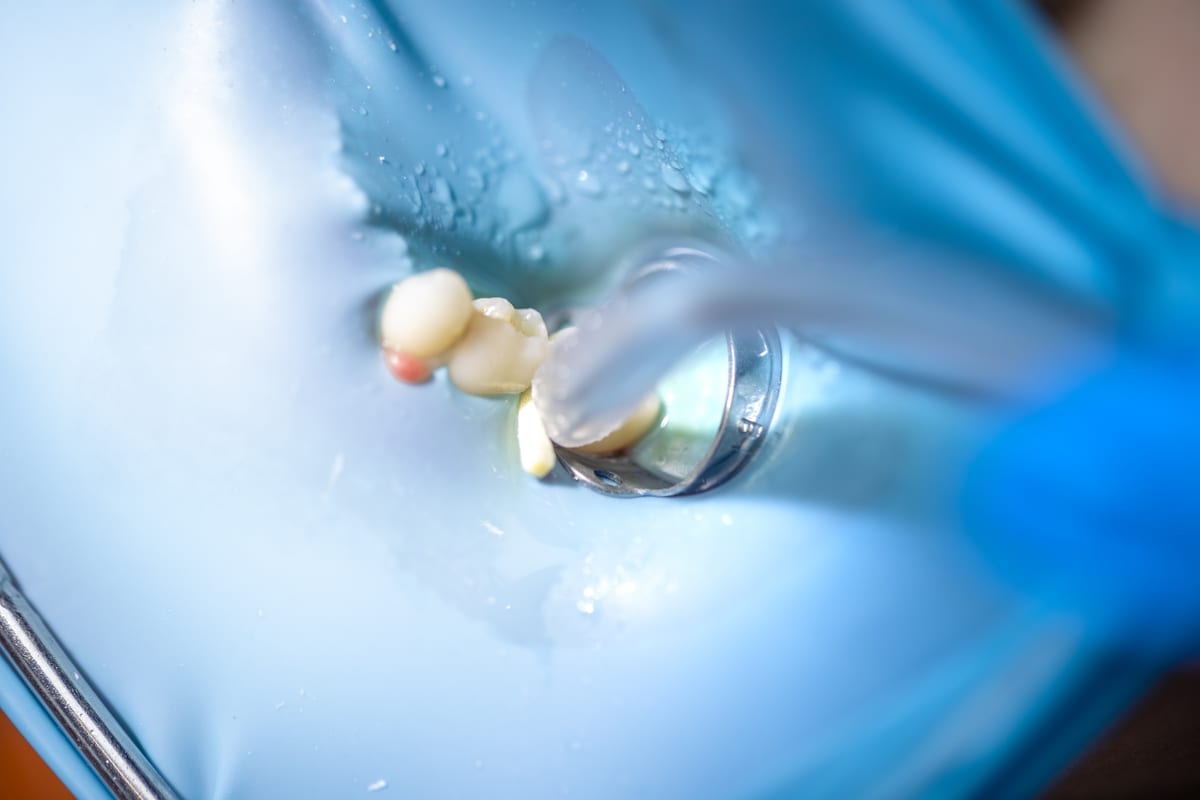 Root Canal Treatment in Pocatello